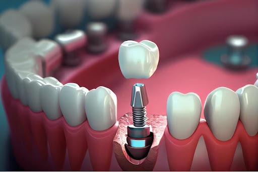 Dental Implants Same Day Houston