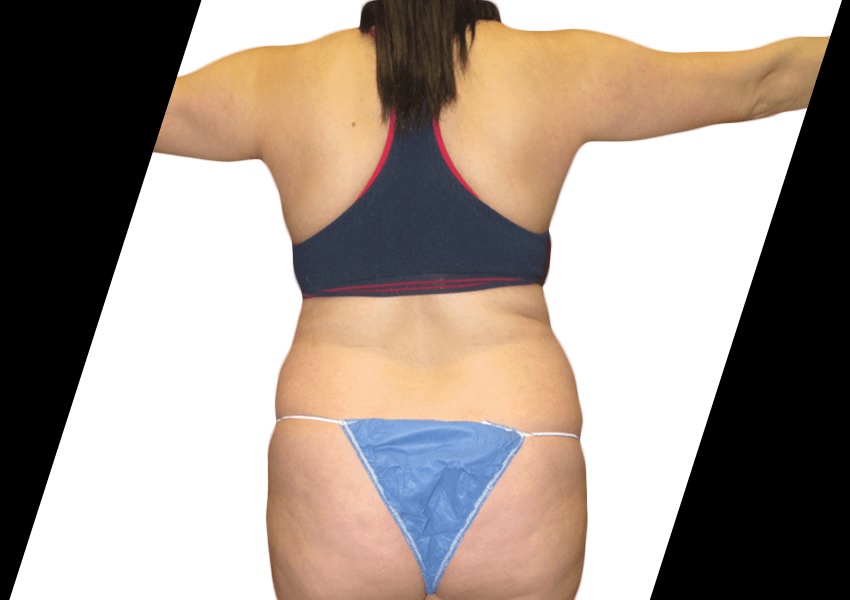 body contouring specialist houston