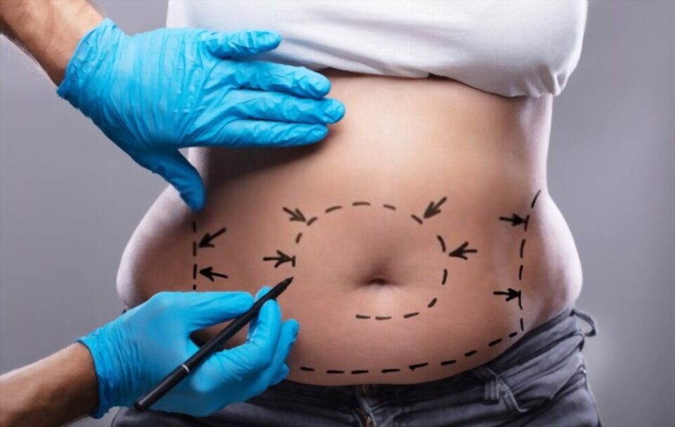 Abdominoplasty