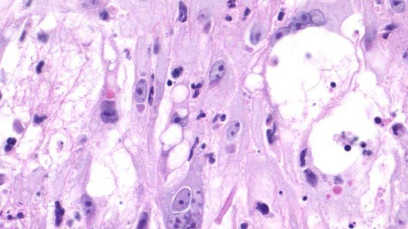 The primary innoculation lesion for monkeypox infection.