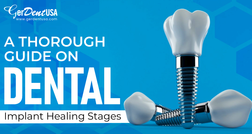 dental-implants-healing-stages