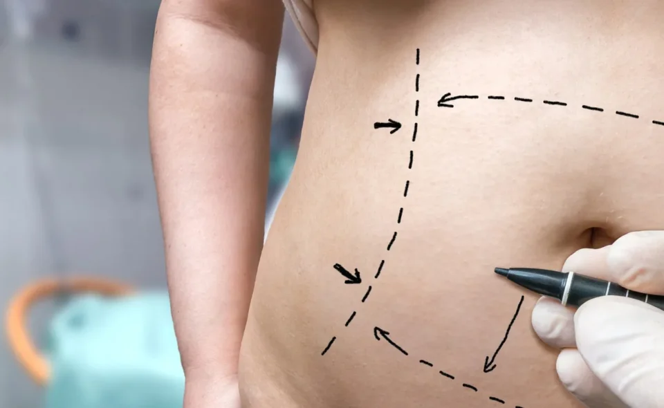 What is Vaser liposuction