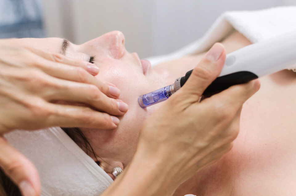 What Is Microneedling And How Does It Work