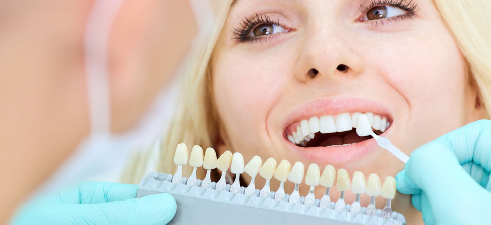 dental veneers costs