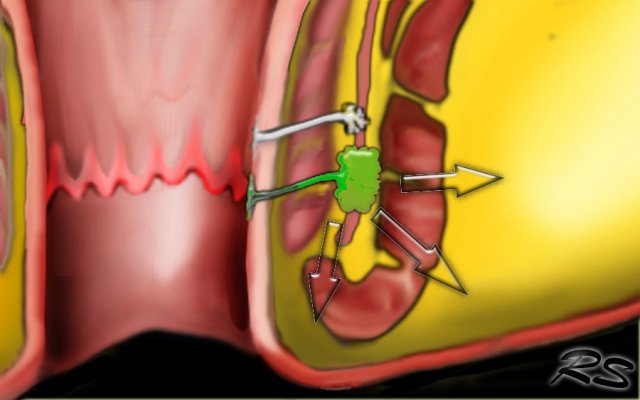 Fistulagrams Farmington