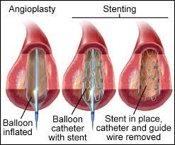 Fistulagrams Farmington