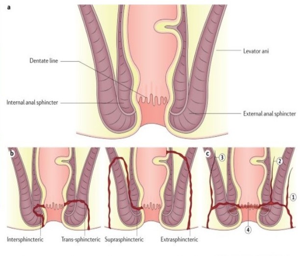 Fistulagrams Farmington