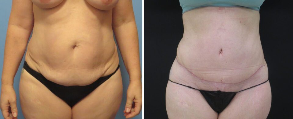 Liposuction Near Me