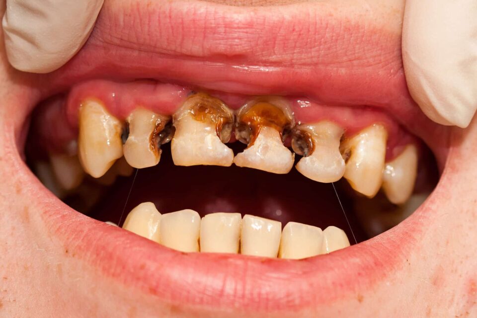 treatment of tooth abscess