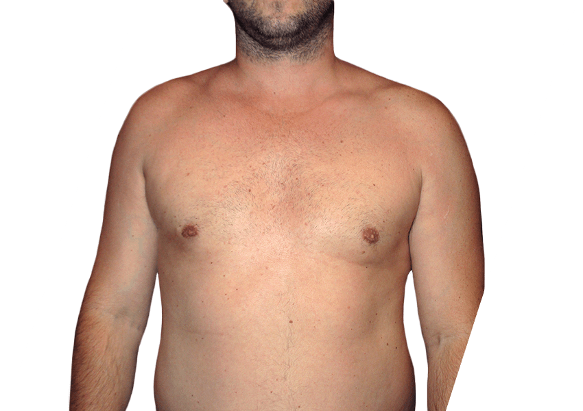 liposuction houston