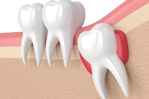 wisdom tooth pain