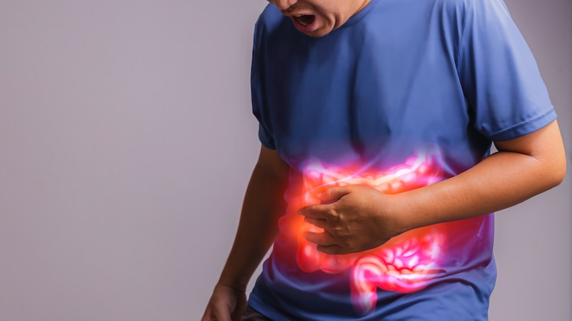 Ulcerative Colitis