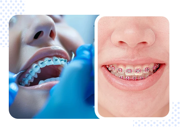 invisalign braces