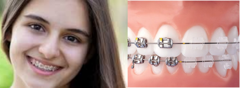 dental implant in jaipur