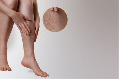 what kind of specialist treats varicose veins