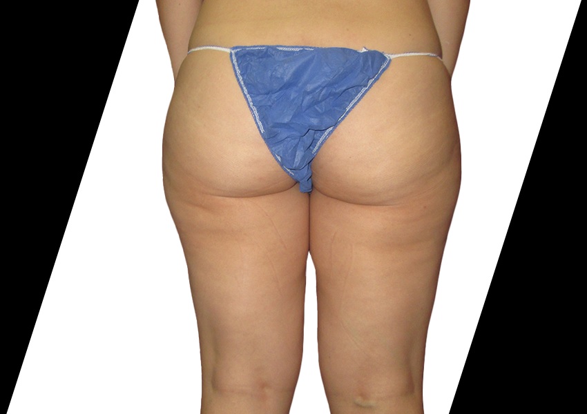 Liposuction Before And After