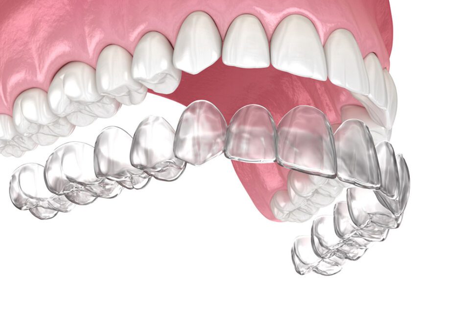 Invisalign braces or invisible retainer. Medically accurate dental 3D illustration