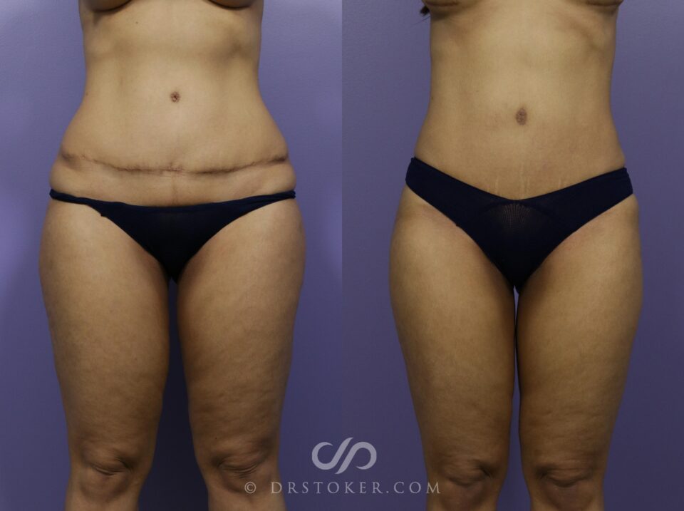 tummy tuck before and after